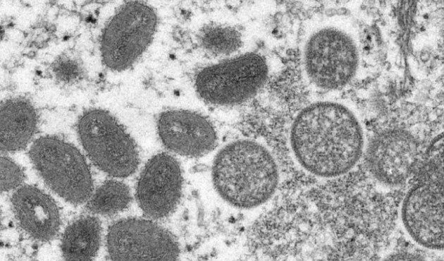 Após Europa, Estados Unidos confirmam primeiro caso de varíola dos macacos